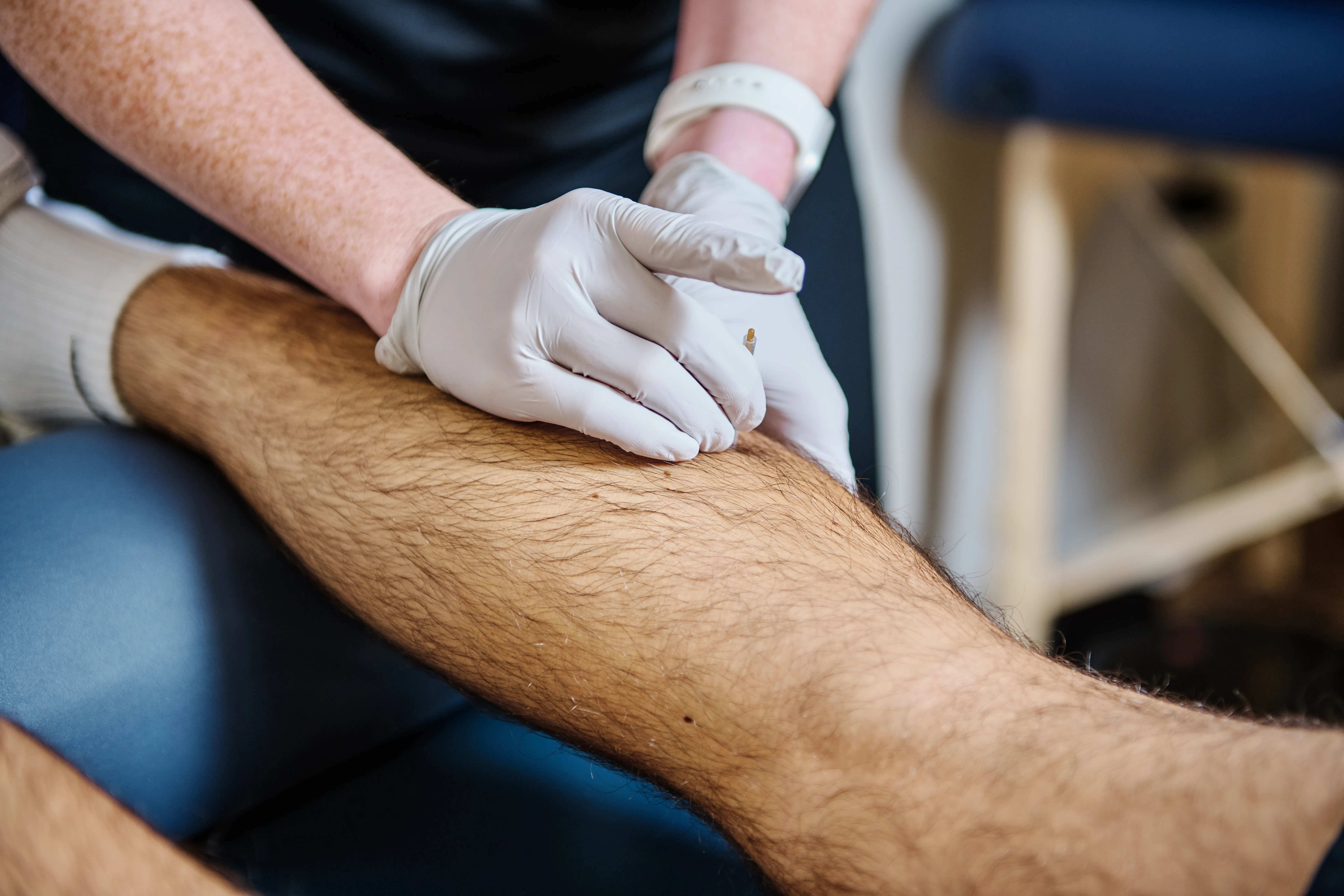 Healthcare professional performing acupuncture treatment on a patient's leg, focusing on specific points with precision.